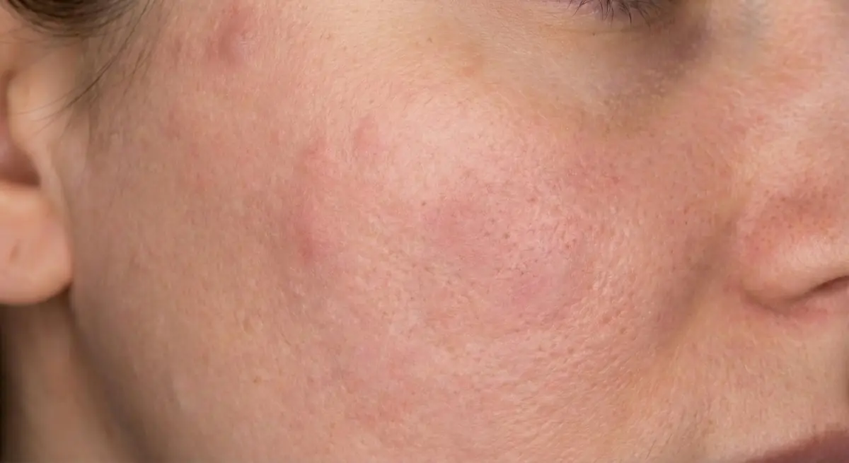 After Severe Cystic Acne