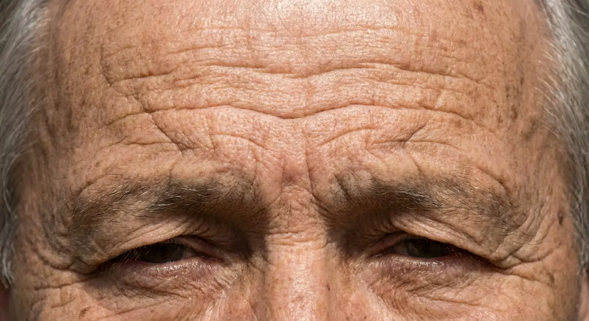 Before Botox for Dynamic Wrinkles