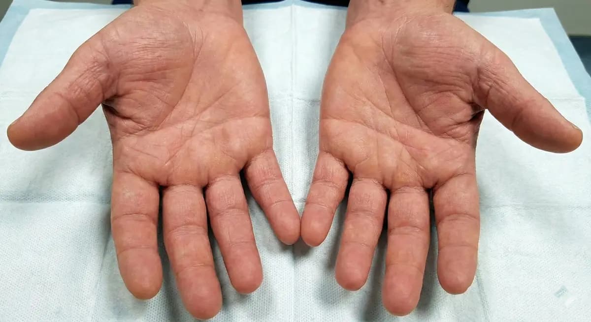 After Chronic Hand Eczema