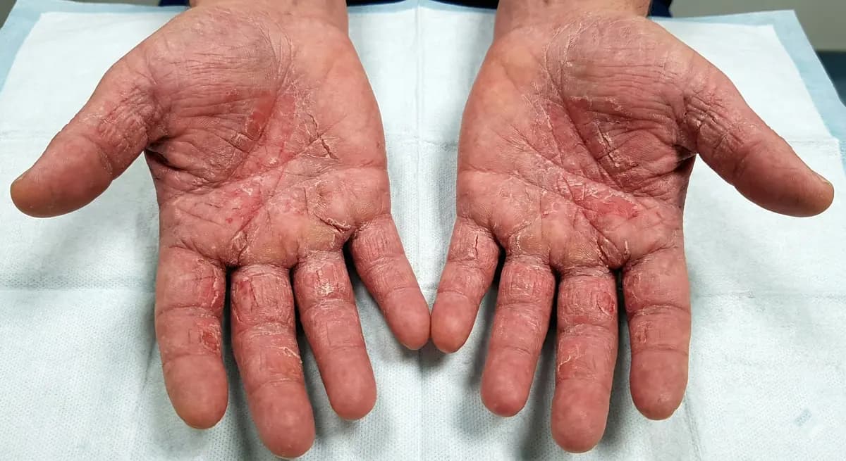 Before Chronic Hand Eczema